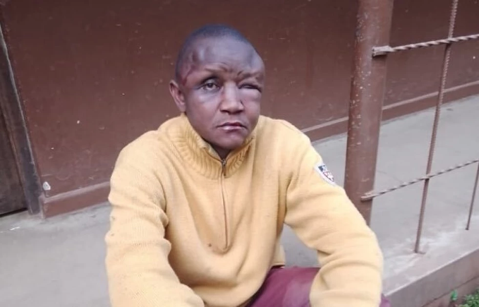 Thug left with ‘disfigured dental arrangement’ after botched robbery in Kileleshwa