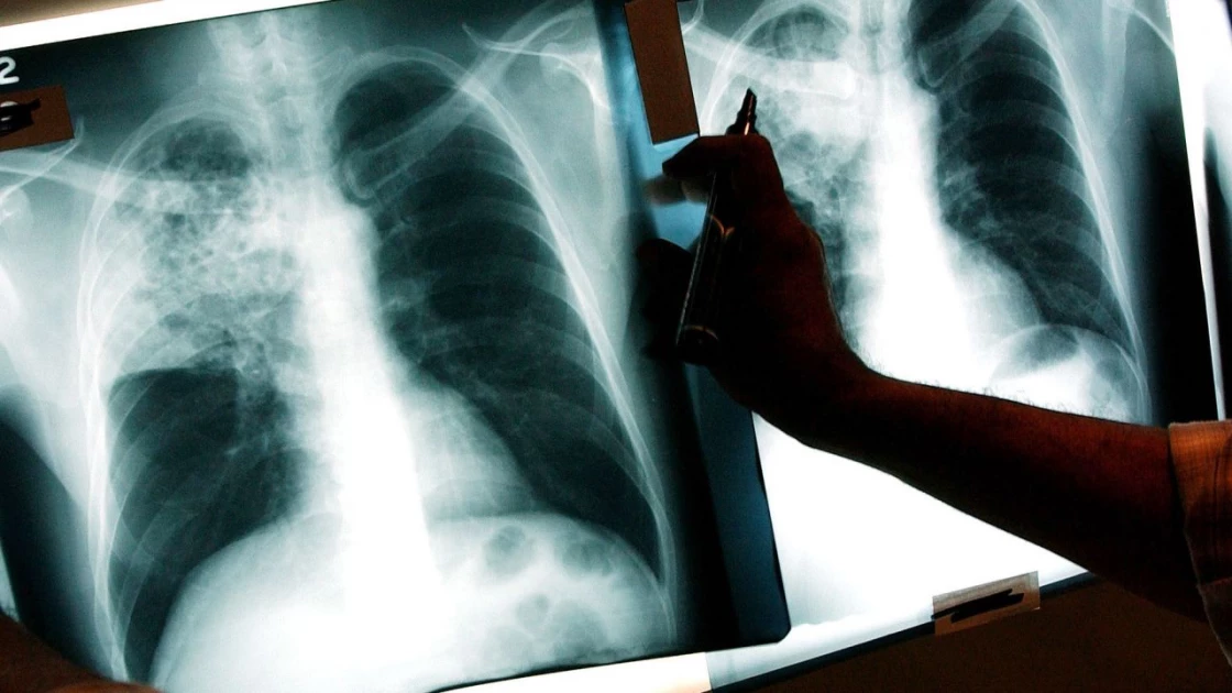 Clinical trials show promise for new TB vaccines