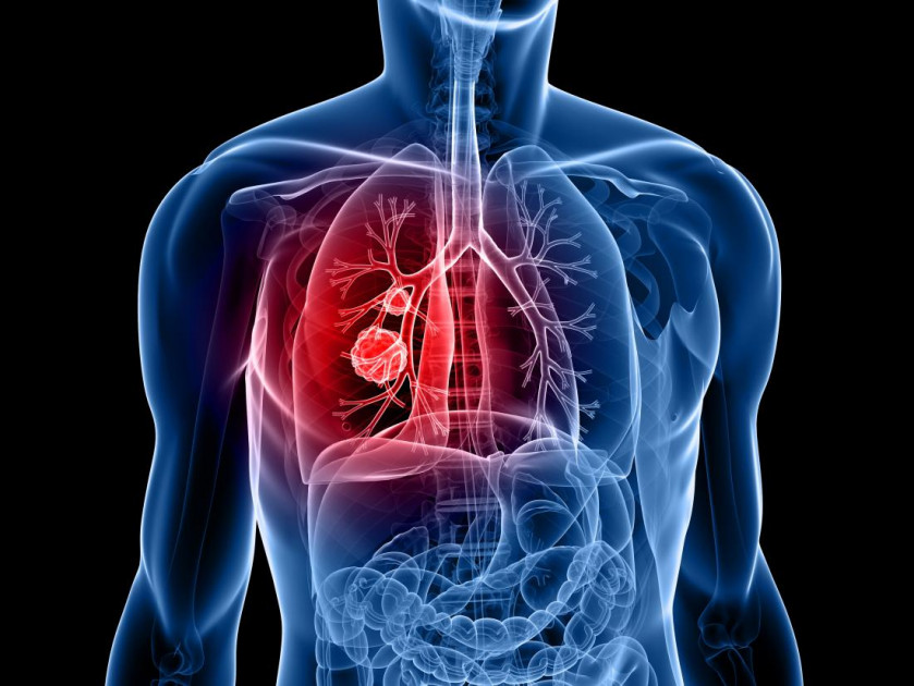 Early symptoms of lung cancer